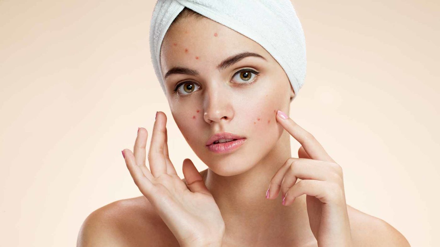 Top Natural Home Remedies To Treat Acne