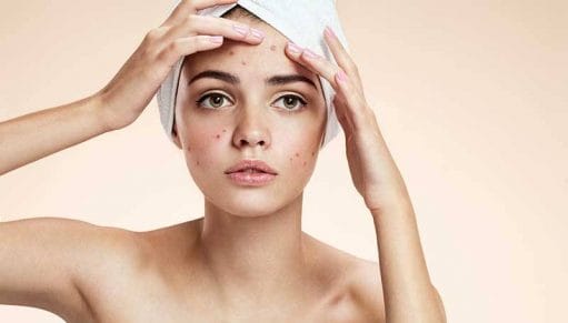 Acne: Do's and Don'ts FITBYNET
