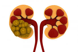 Suffering from Kidney Stones? Try These 6 Natural Remedies now!