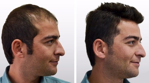 All about Hair Transplant!