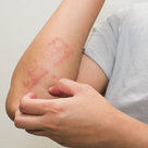 Psoriasis