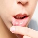Ulcer