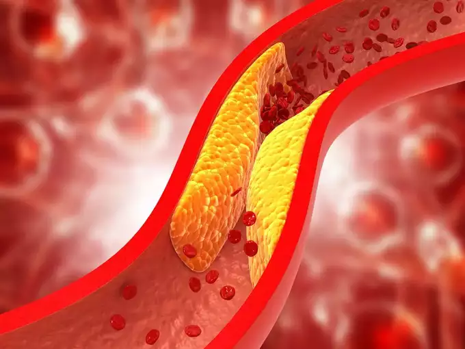 Top tips to reduce cholesterol level in the body