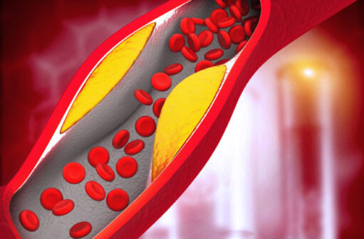 Suffering from high Cholesterol? This Is How You can Bring it Down