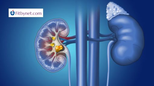 Kidney Stones Treatment - Fitbynet