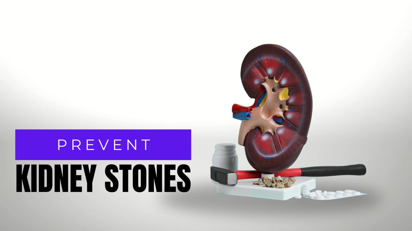 Prevent Kidney Stones - Fitbynet