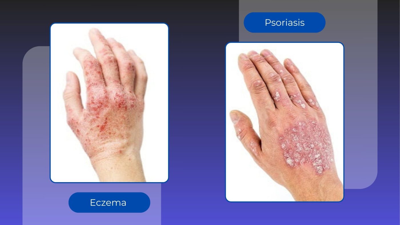 Eczema vs. Psoriasis