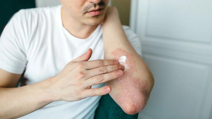 psoriasis treatment