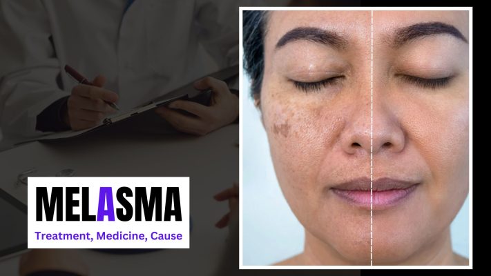 Melasma-Medicine-Treatment